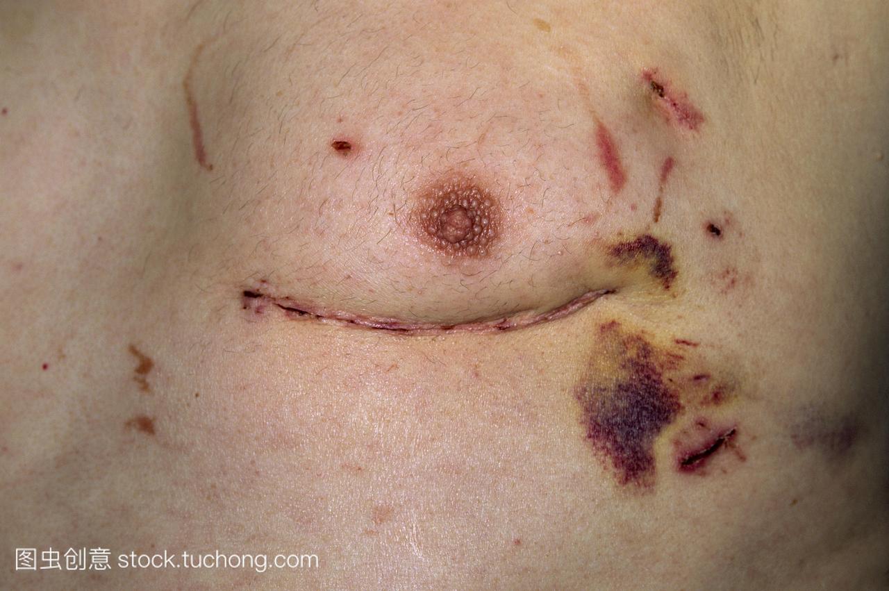 58岁男子的胸口的伤疤后11天冠状动脉搭桥手