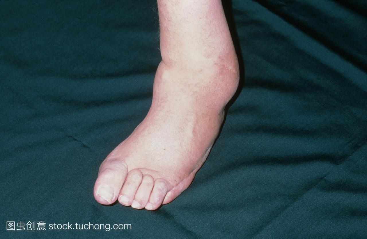 神经性的脚。畸形的病人的脚和脚踝由于神经病