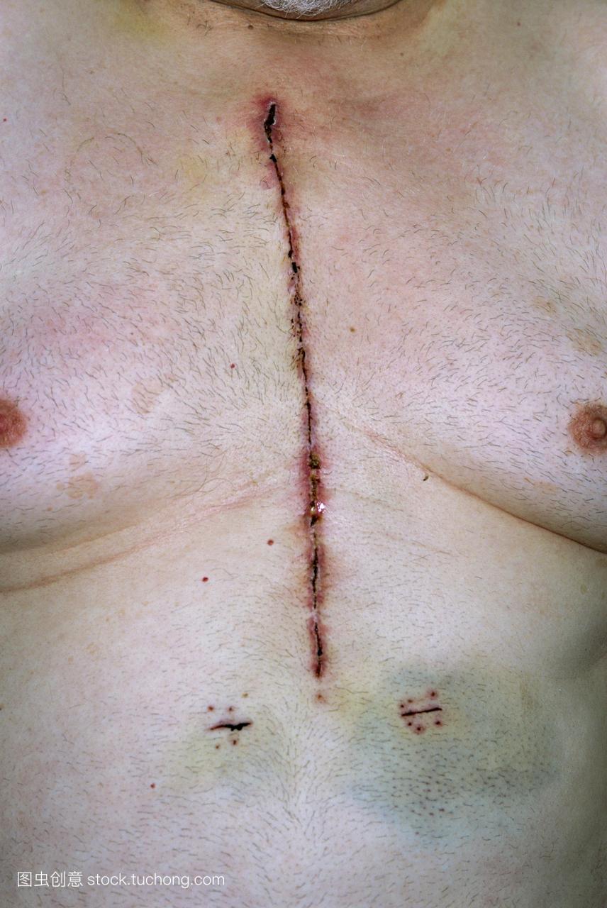 疤痕的胸部56岁男子11天冠状动脉搭桥手术ca