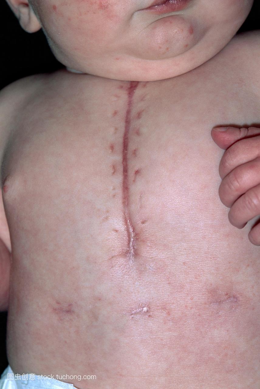 心脏手术疤痕在一个3个月大的婴儿的胸部。这
