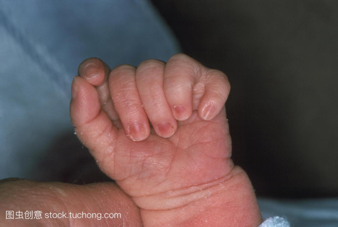 多指趾畸形。婴儿的手的特写镜头显示一个额外
