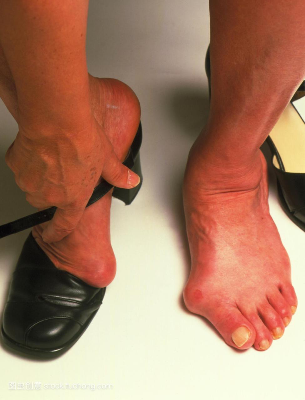 拇囊炎对女性的脚阻止她适合她的鞋子。拇外翻
