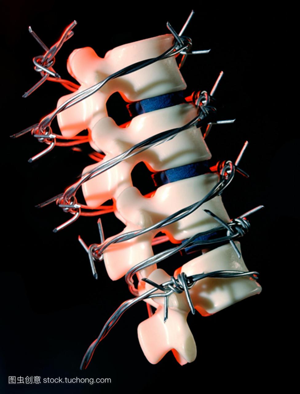背部疼痛。用带刺的金属线包裹的脊椎部分模型