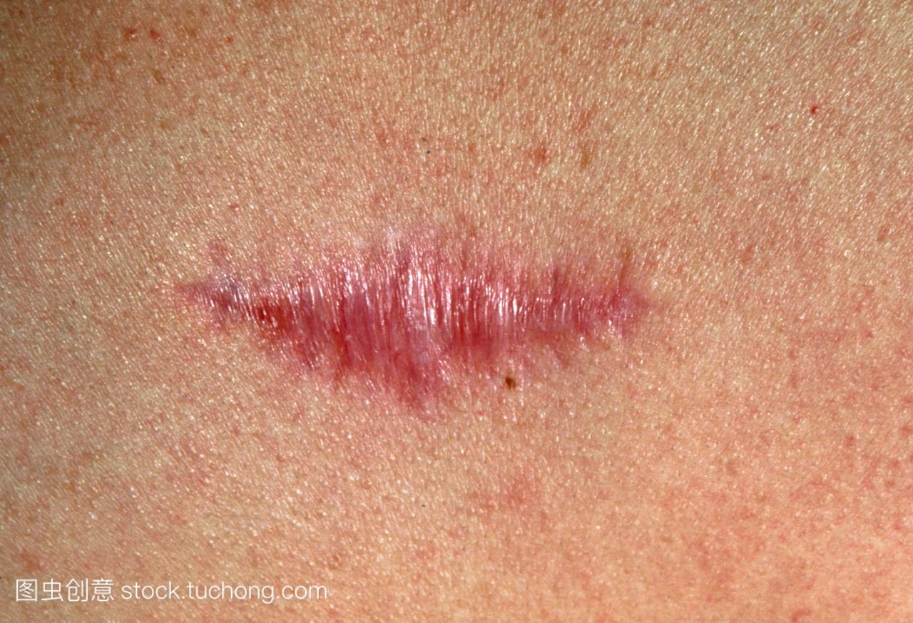 瘢痕疙瘩疤痕。特写的伤疤可能一个瘢痕疙瘩的