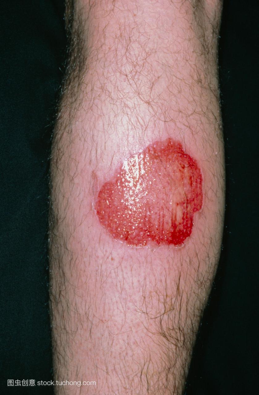 感染燃烧腿感染烧上一个男人的小腿由于蒸汽清