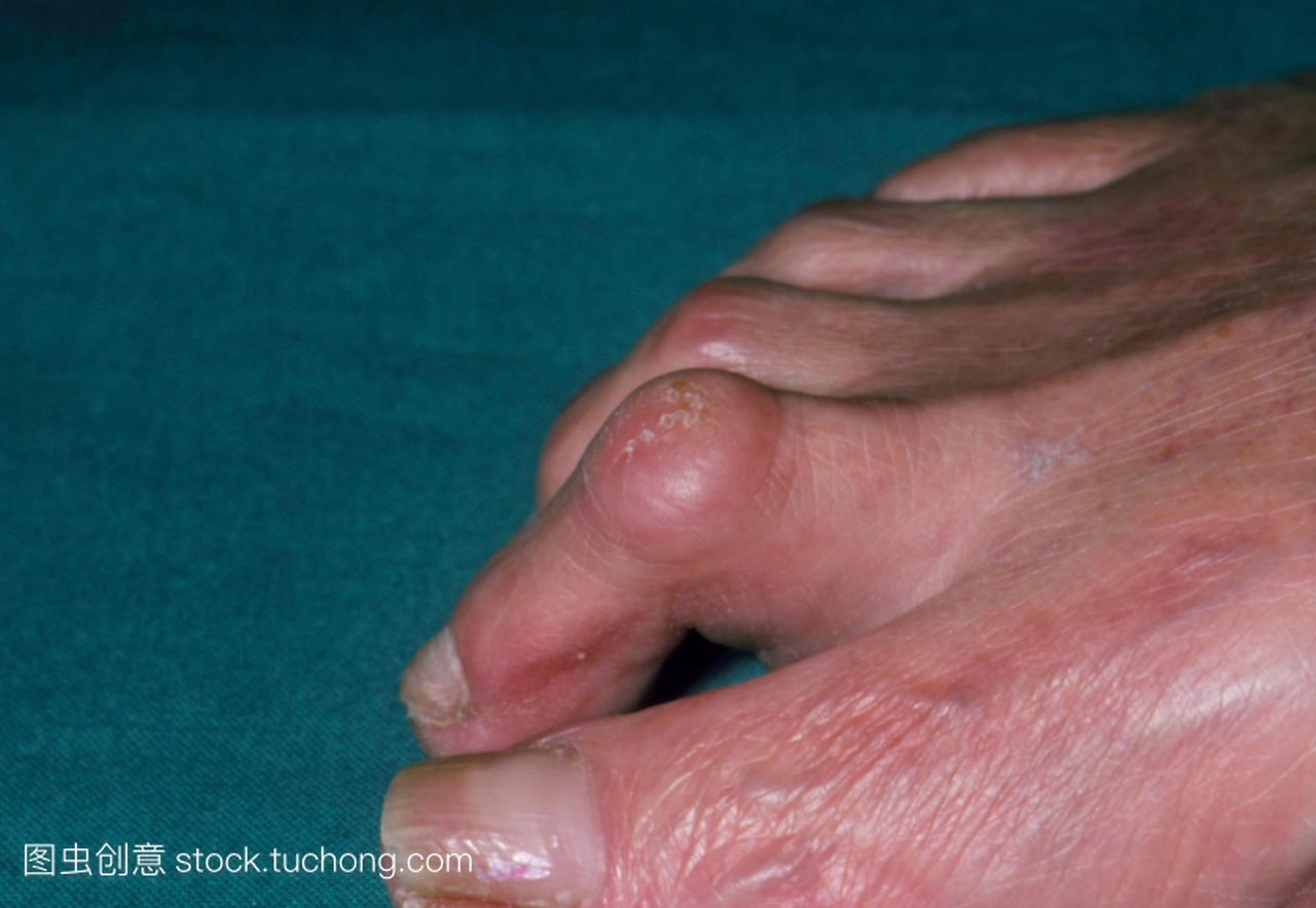 锤脚趾。成人第二趾畸形,由第一个关节的固定