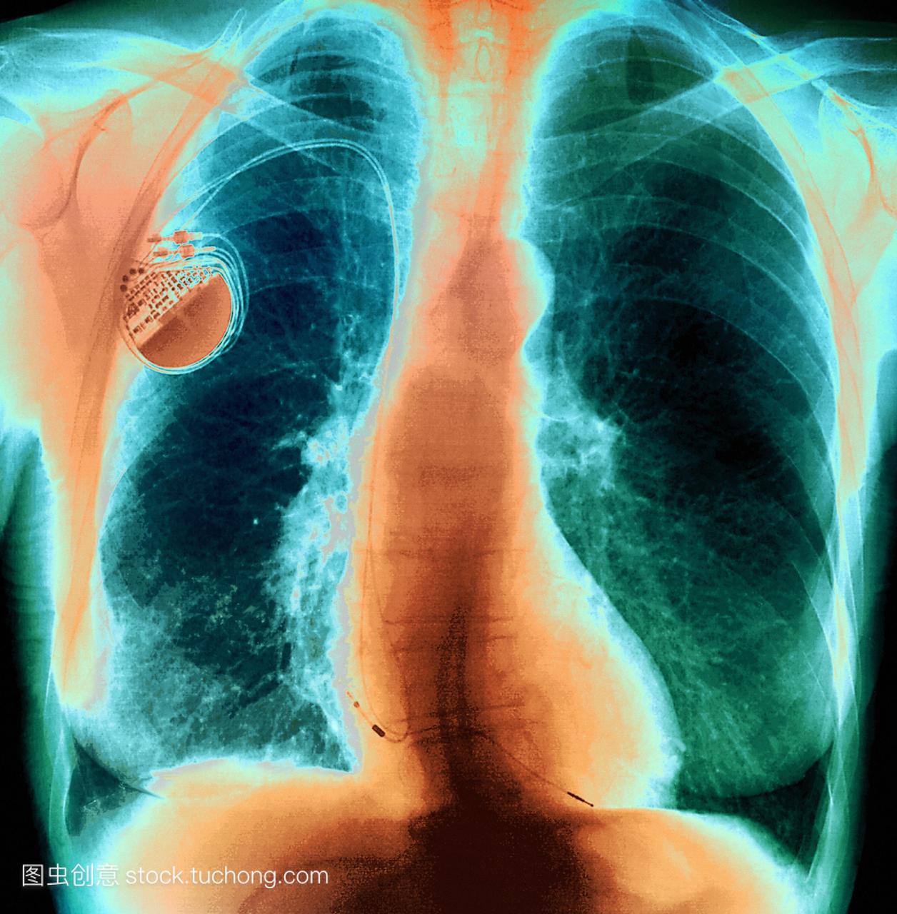 心脏起搏器。彩色胸部x光片显示心脏移植心脏
