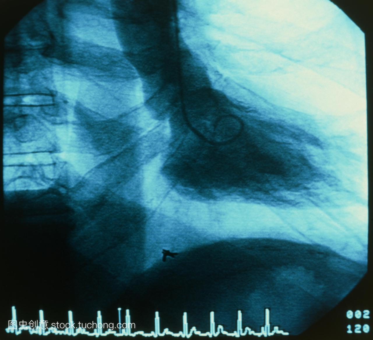在接受心脏导管检查时,患者胸部的x光图像。导