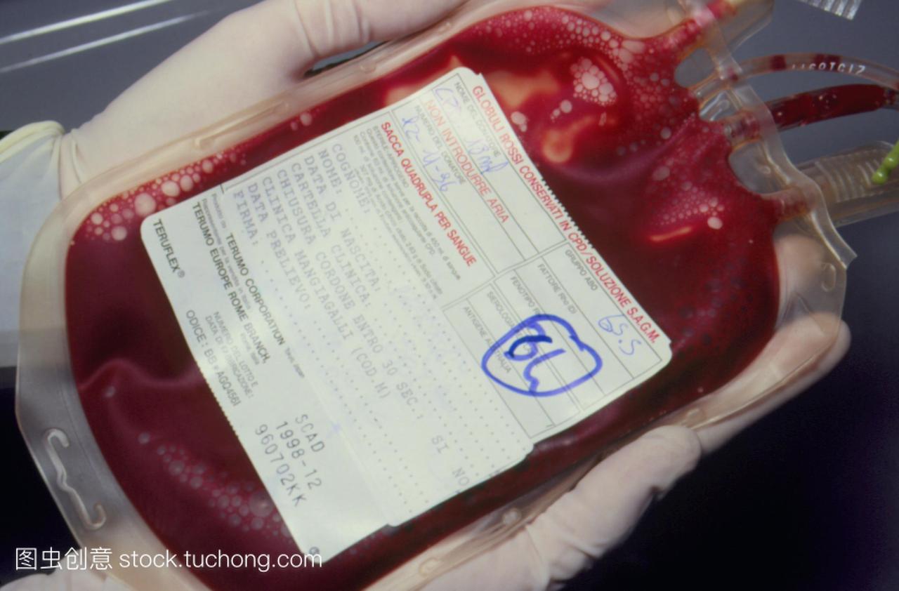 手拿着一个塑料袋含有血液。这血液来自孕妇的