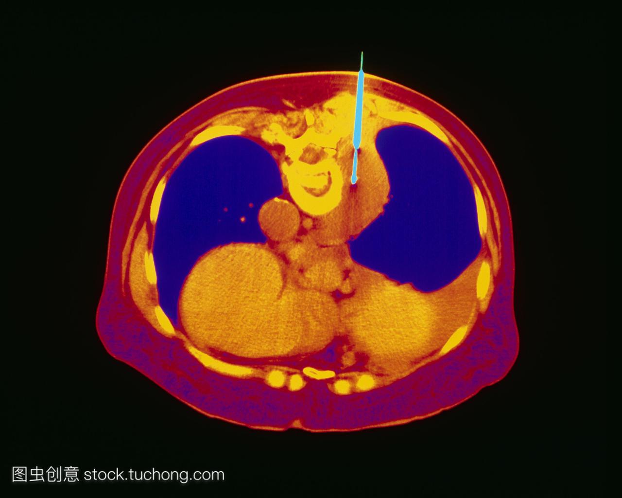 肺活检。彩色计算机断层扫描ct扫描在人的胸部