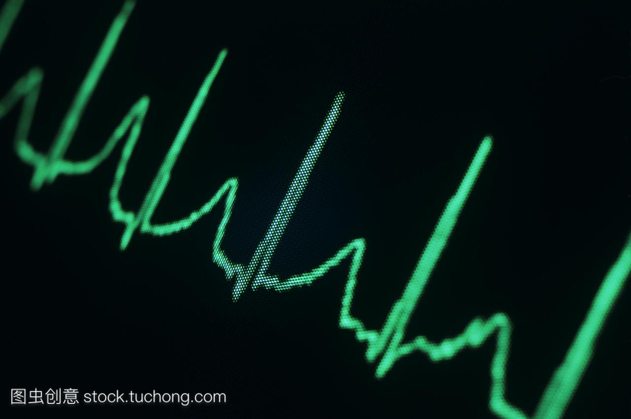 心电图ecg的正常心率。心电图测量心脏的电活