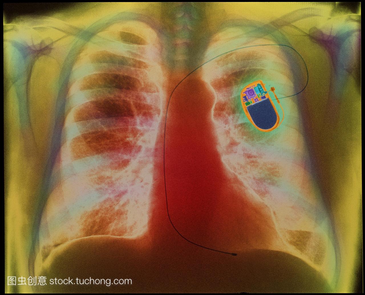 心脏起搏器。彩色的胸部x光一个病人显示安装