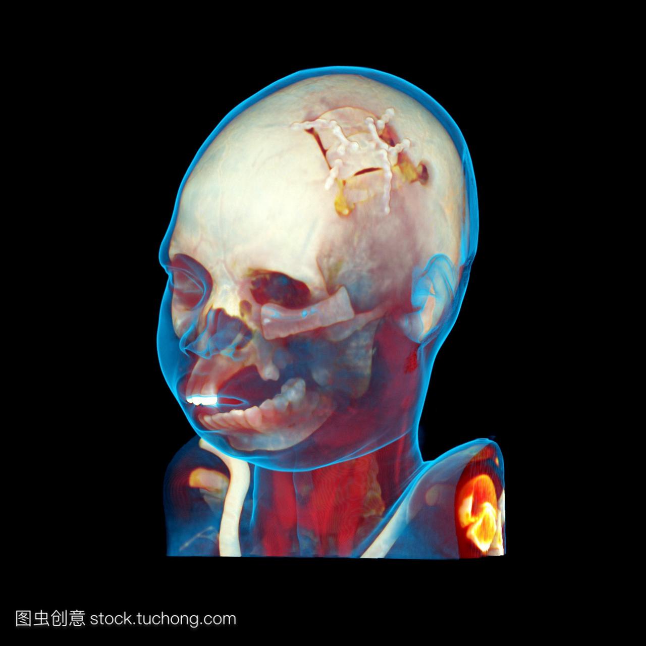 面部重建CT扫描。彩色三维计算机断层扫描C