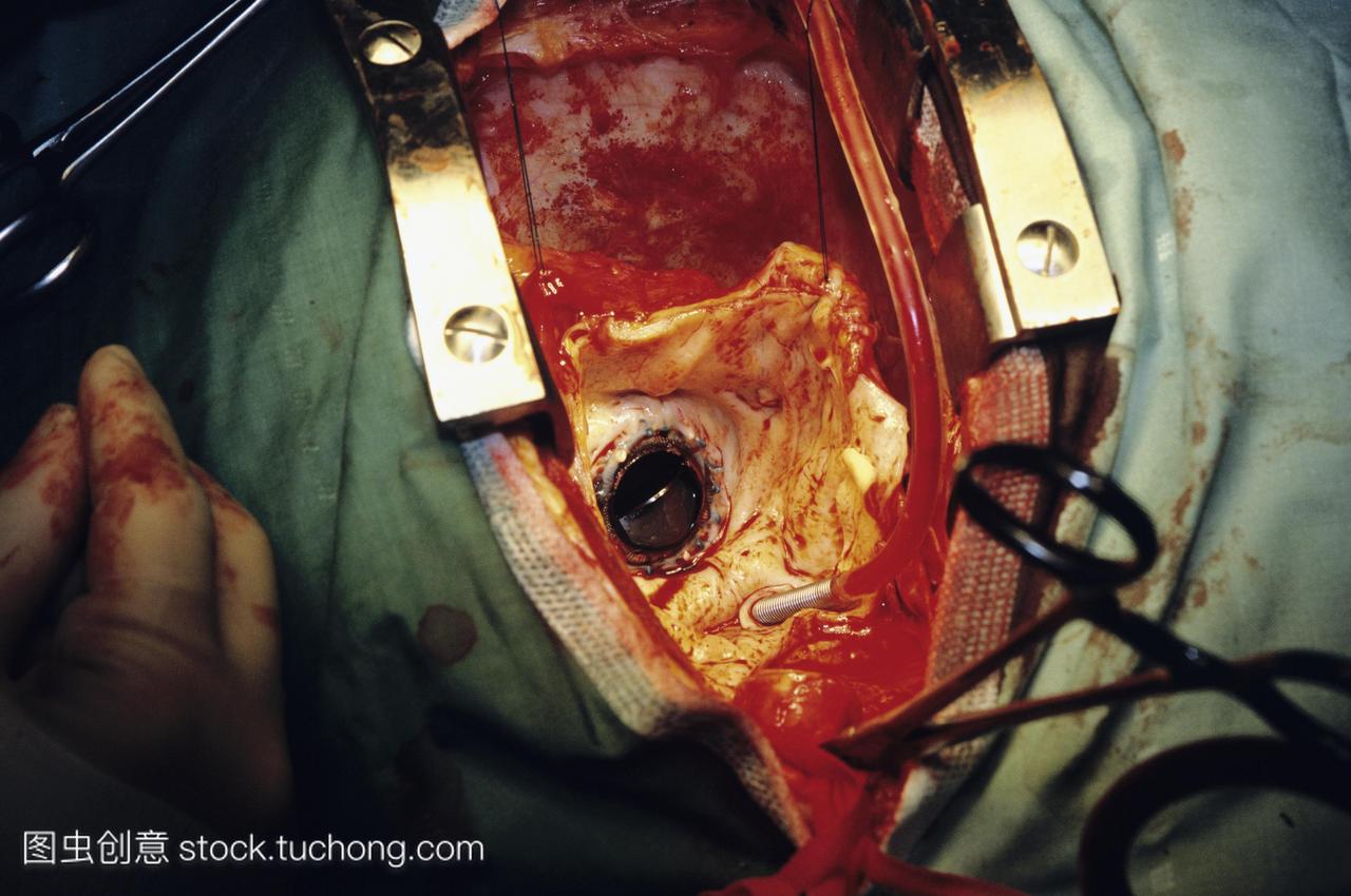 心脏手术。图片4的9。人工瓣膜在心脏修复的