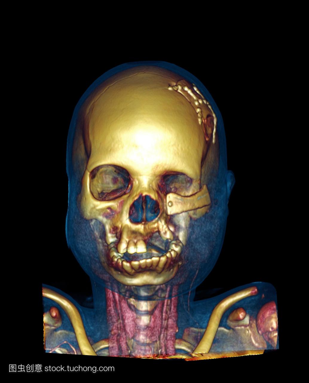 面部重建CT扫描。彩色三维计算机断层扫描C