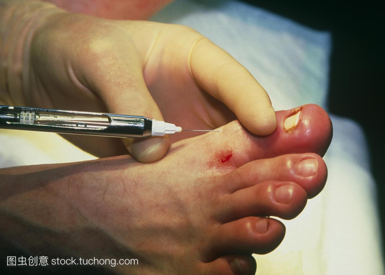 麻醉剂,在手术前将其注射到一个人的大脚趾的