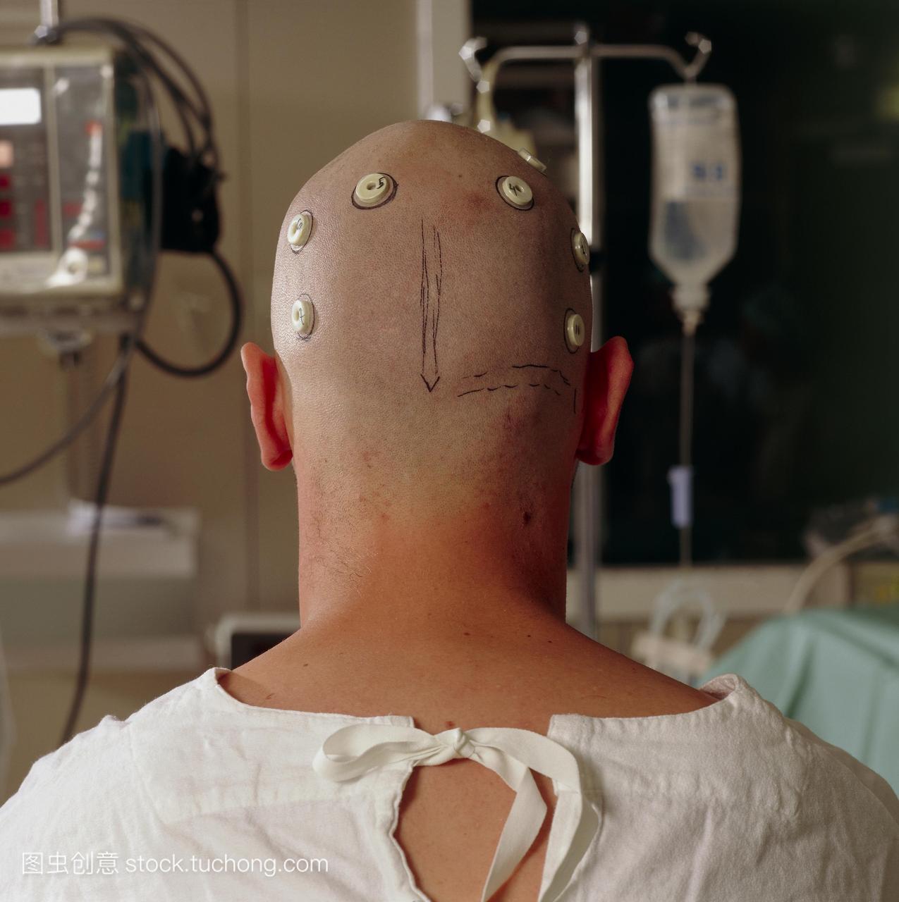 标记放置在皮肤上病人的头部使用mri扫描ct或