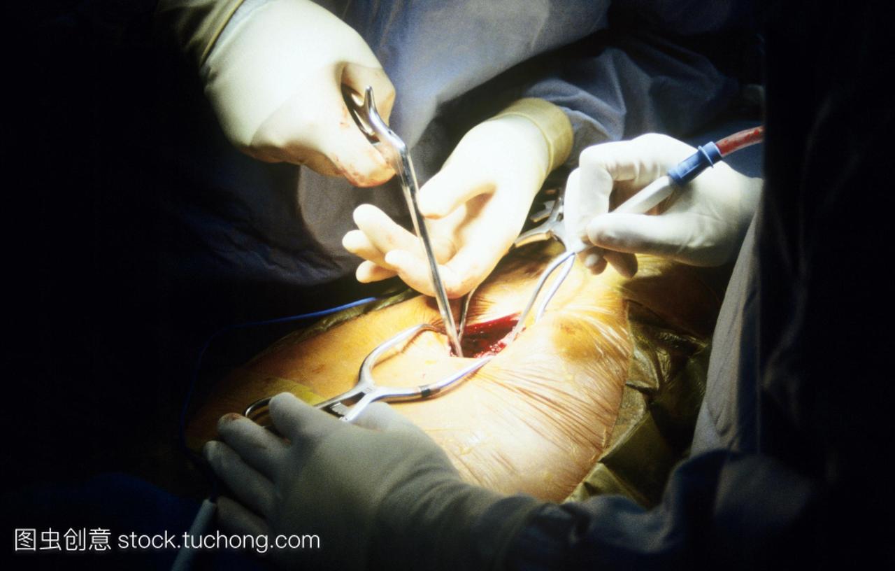 钳咬骨钳删除从脊柱骨一个过程称为椎板切除术