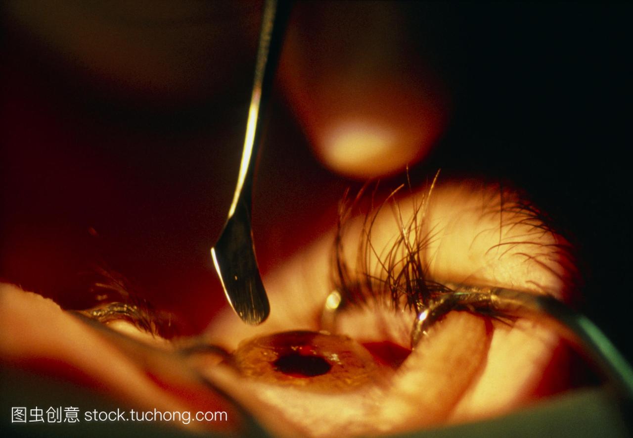 激光手术病人的眼睛特写。这是一种治疗近视,