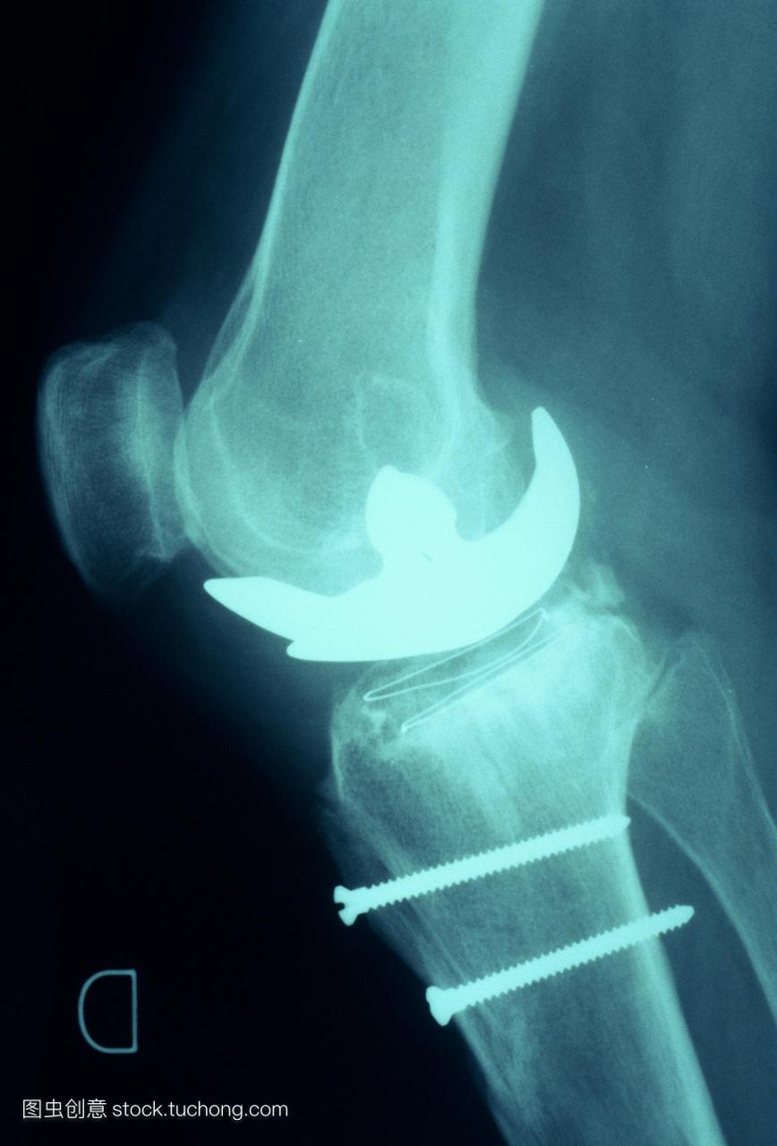假膝盖。x射线的侧面与人工膝关节或假体关节