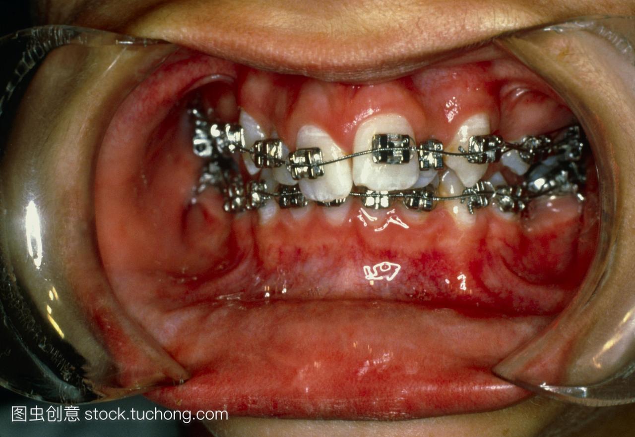 牙套治疗图2。在治疗时,用牙托或牙齿矫正器观