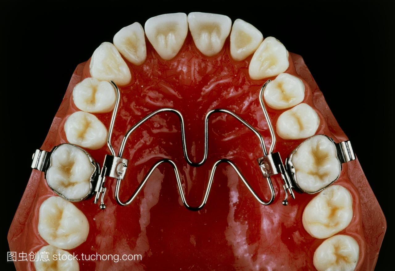 牙科撑。形状记忆合金模型上颌牙撑。括号或矫