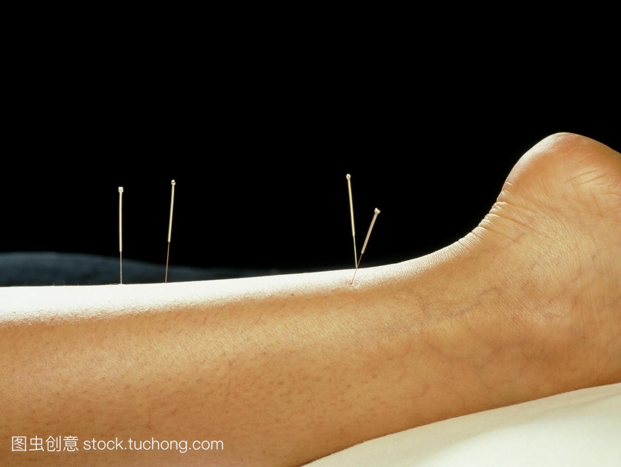 针灸。针灸的针插入到一个女人的腿。几千年来