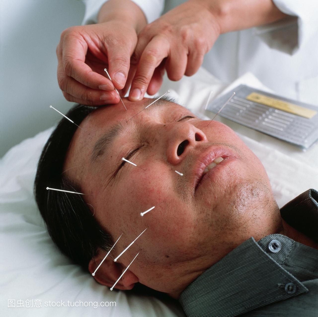 模型发布。针灸。针灸师将针头插入一个人的脸