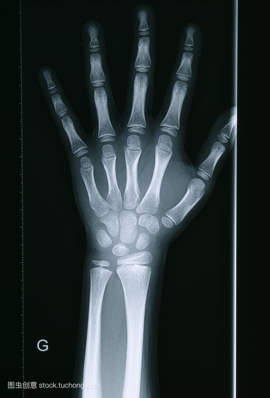 骨龄延迟。x射线的一个10岁的女孩的手和手腕