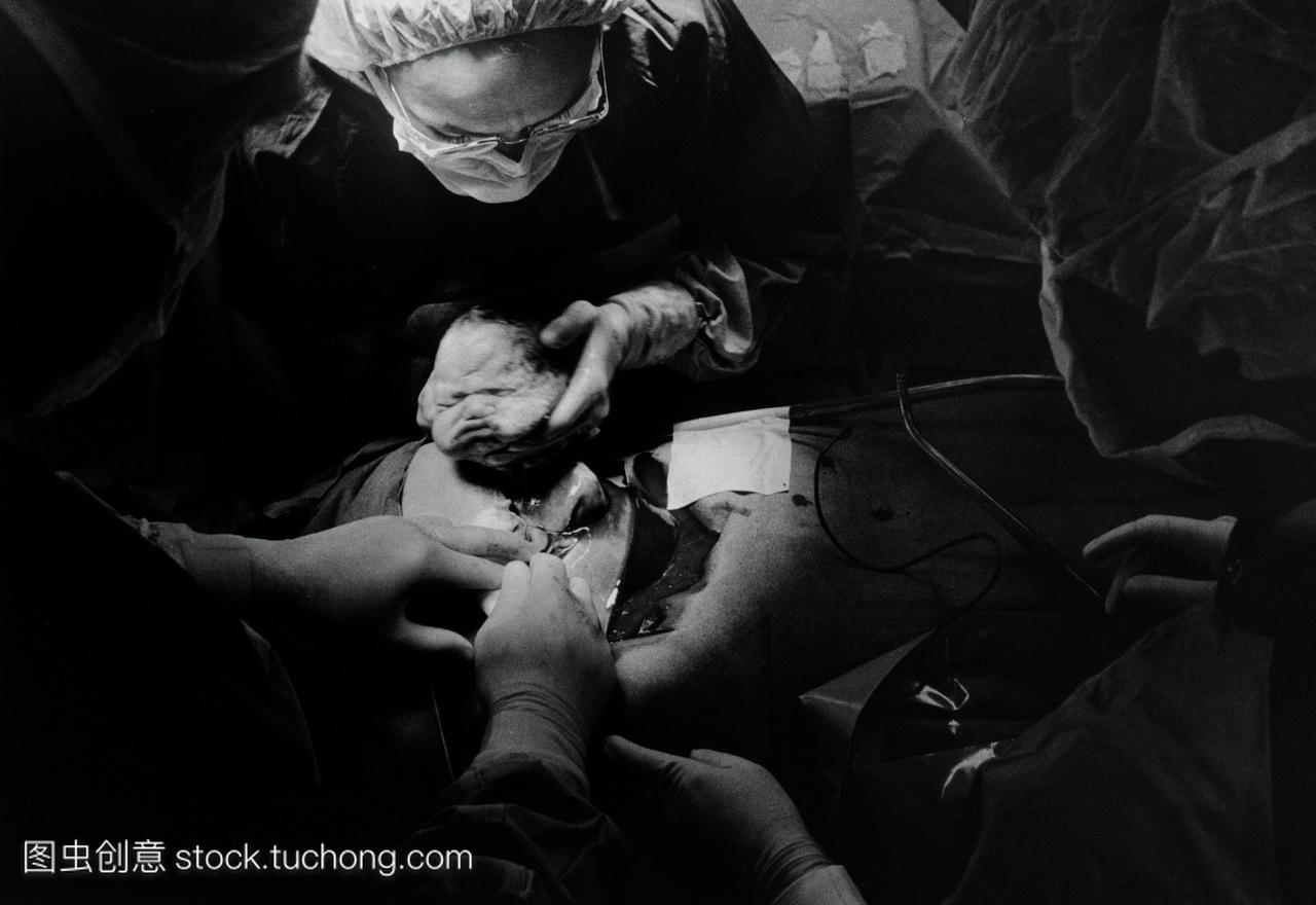 在剖腹产手术中,外科医生通过在母亲腹部切开