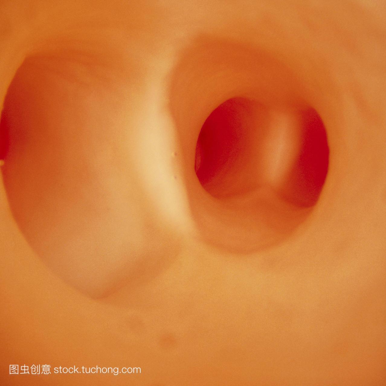 内窥镜图像显示人体动脉内壁腔的出现。两个主