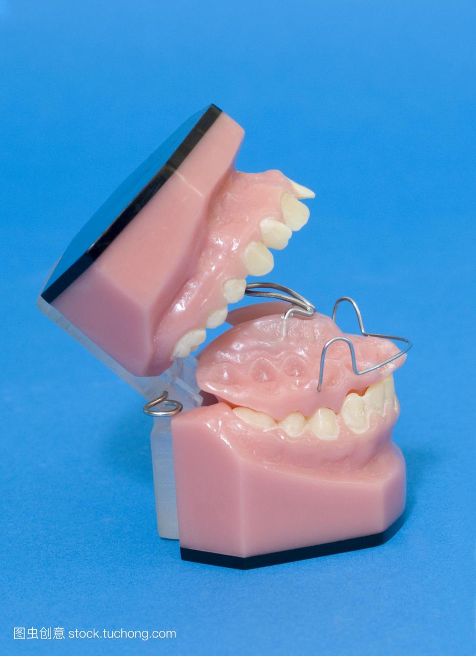 Andreason支架安装在一副假牙。这些括号是旨