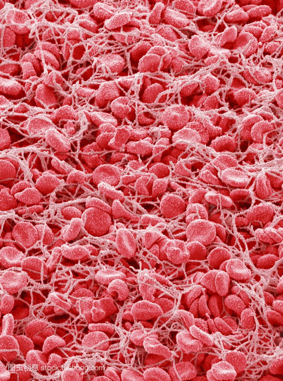 被困在丝纤维蛋白的蛋白质粉色。血液凝固是血