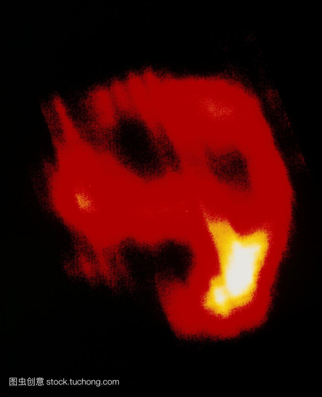 超新星遗迹msh11-54在红外空间天文台iso卫星