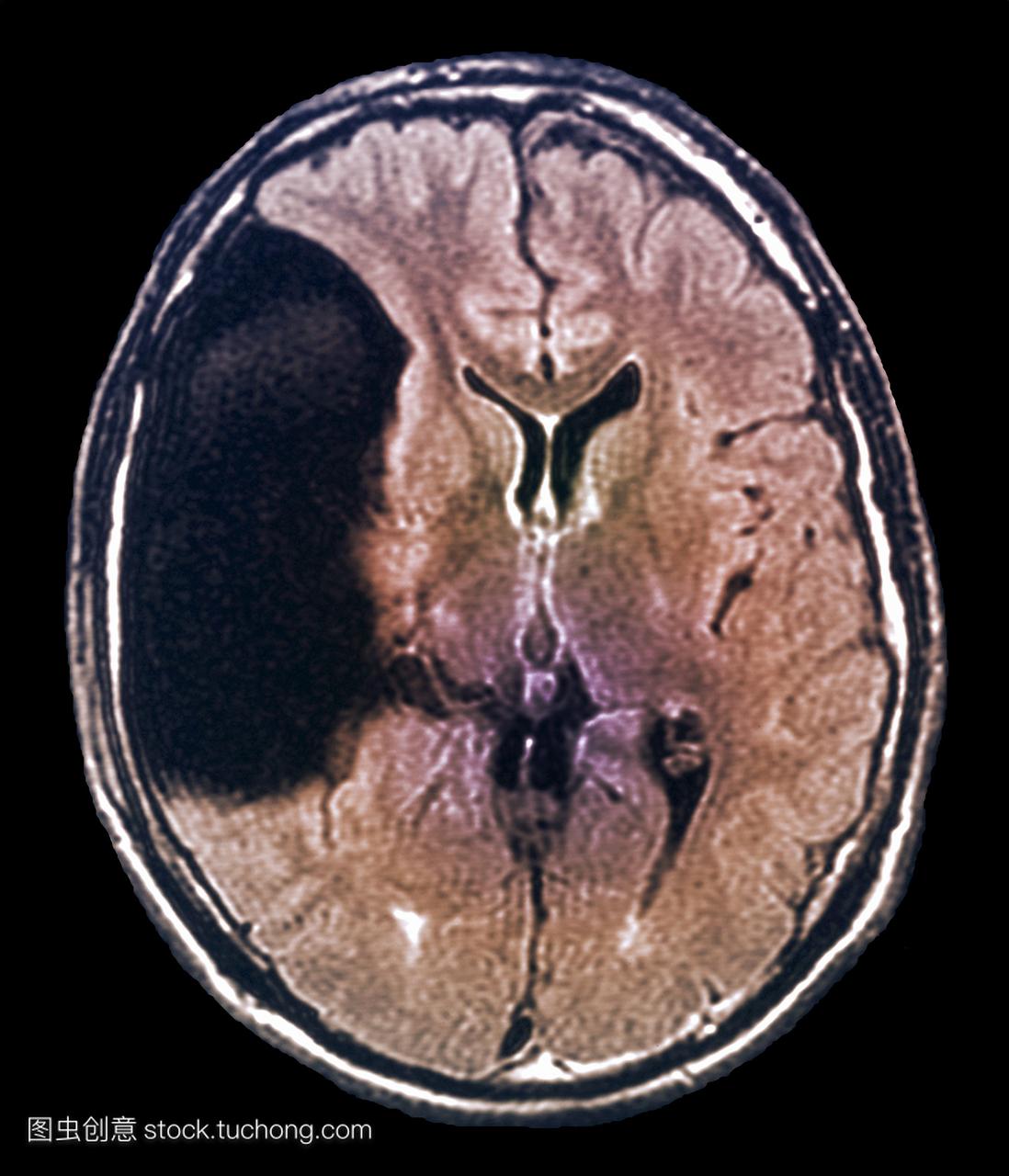 轴向切片扫描,显示在大脑的sylvian裂隙中有一