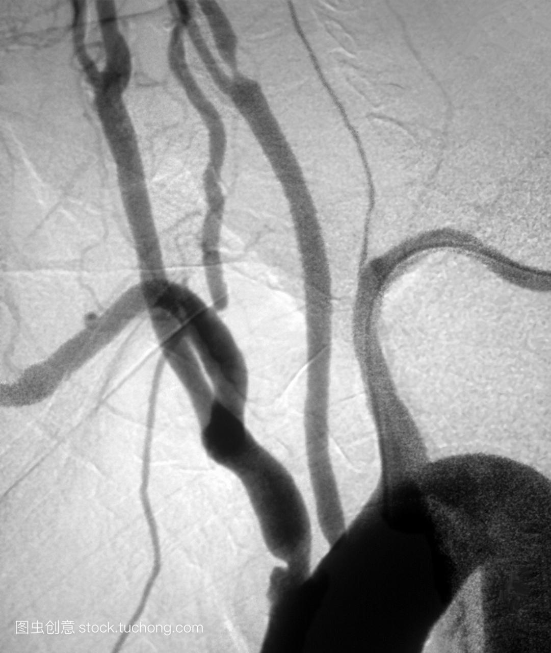 数字化血管造影x射线的动脉分支从主动脉心脏