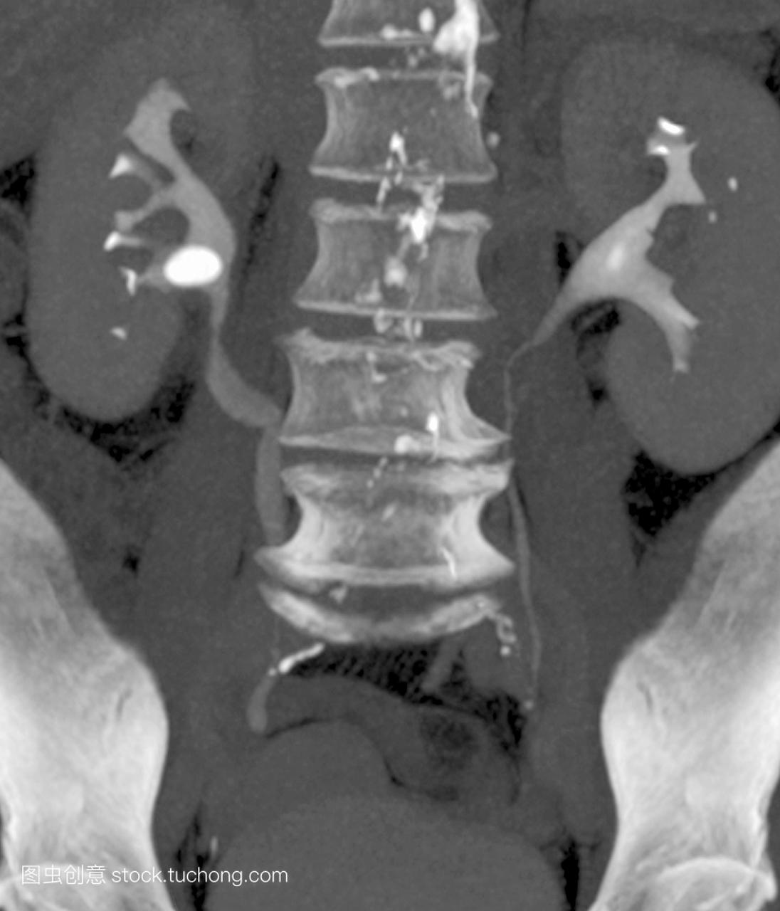 腹部计算机断层扫描CT扫描的病人66岁显示微