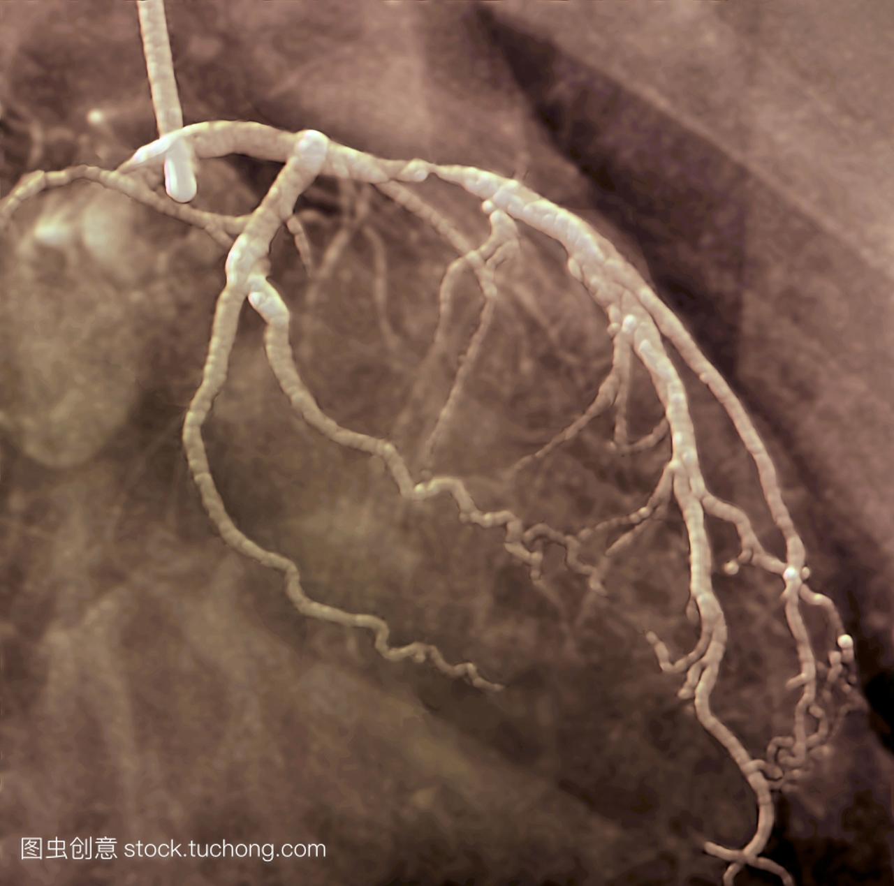 色血管图x射线在59岁的患者心脏左冠状动脉前