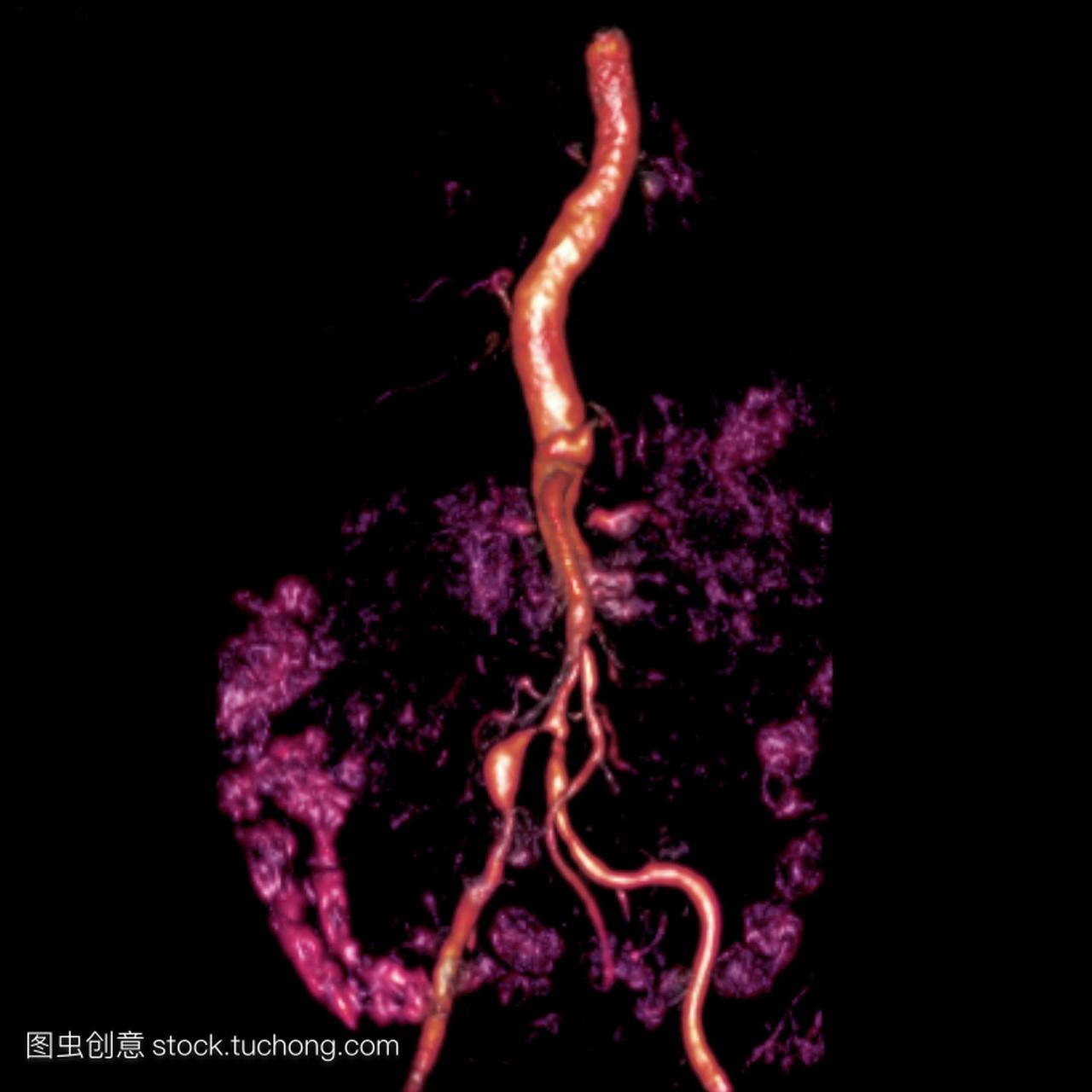 a对77岁男性患者腹部的扫描,显示双侧肾动脉狭
