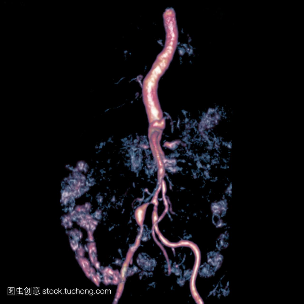 a对77岁男性患者腹部的扫描,显示双侧肾动脉狭