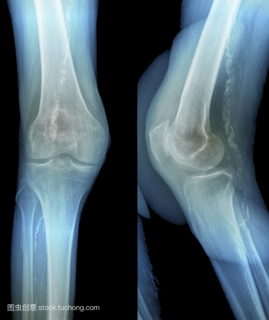 彩色x射线前面和侧面视图的膝关节患者81岁显