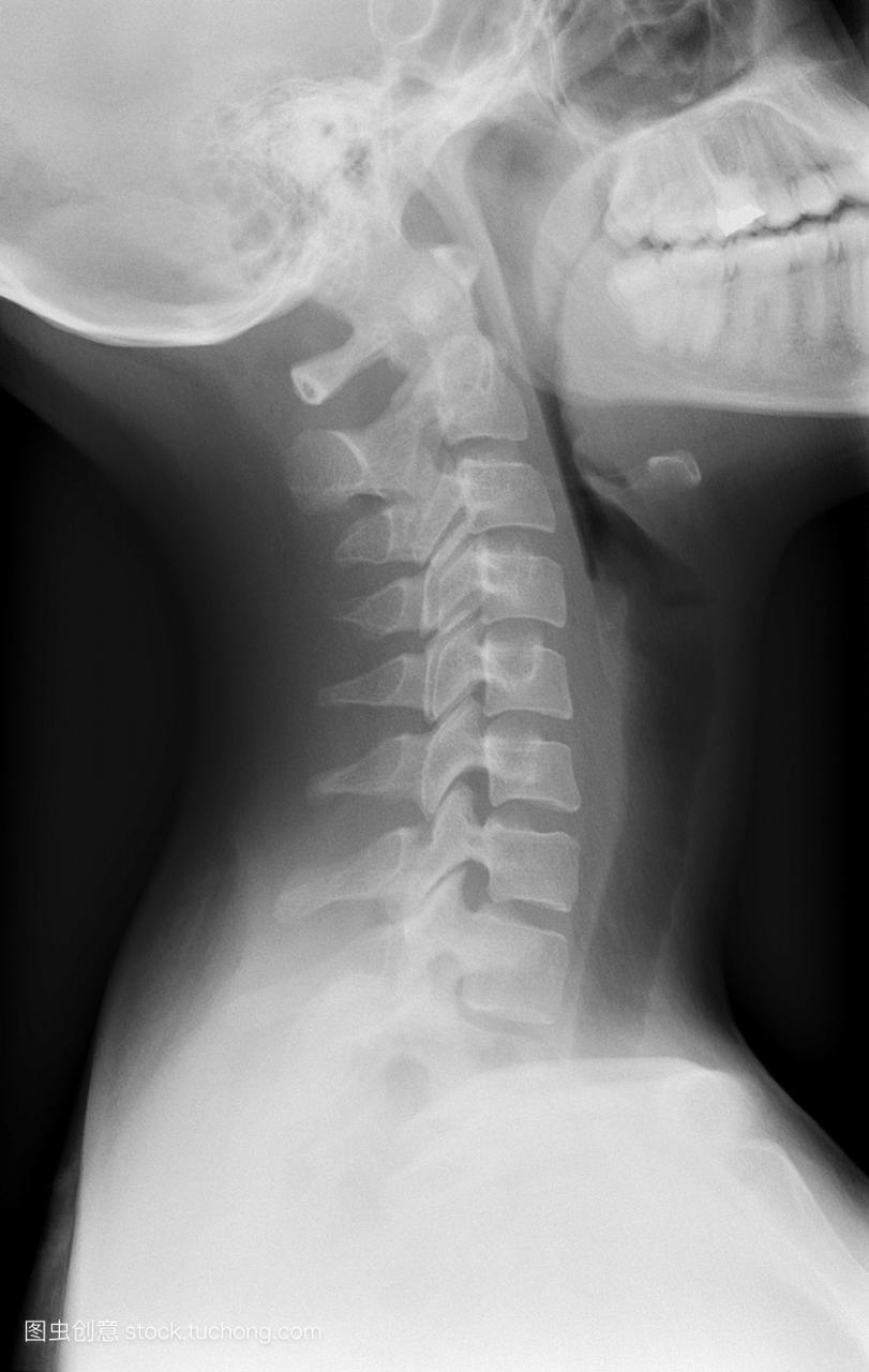 人颈部的x线侧面图,显示颈部健康的颈椎脊骨。