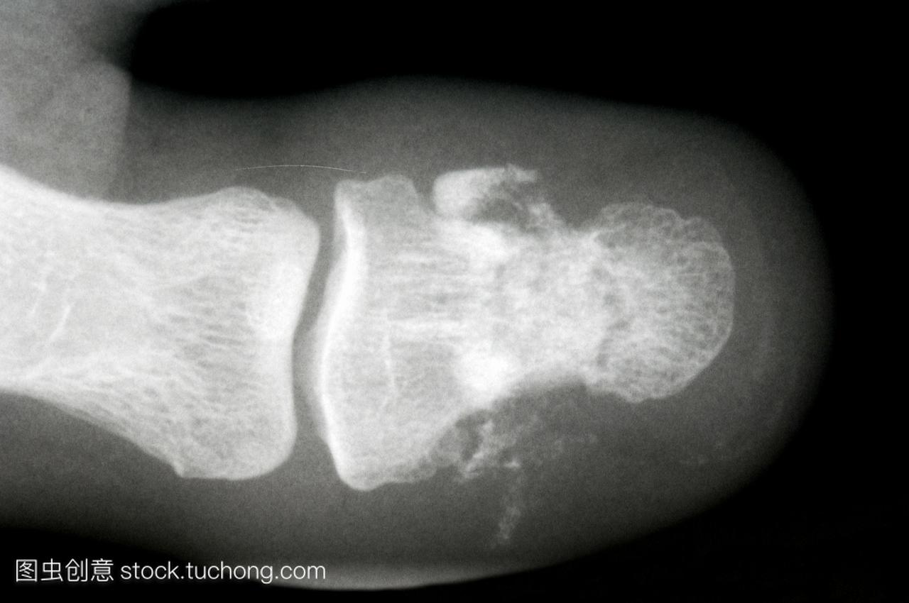 x射线拇趾的成年男性病人显示复合骨折趾骨骨