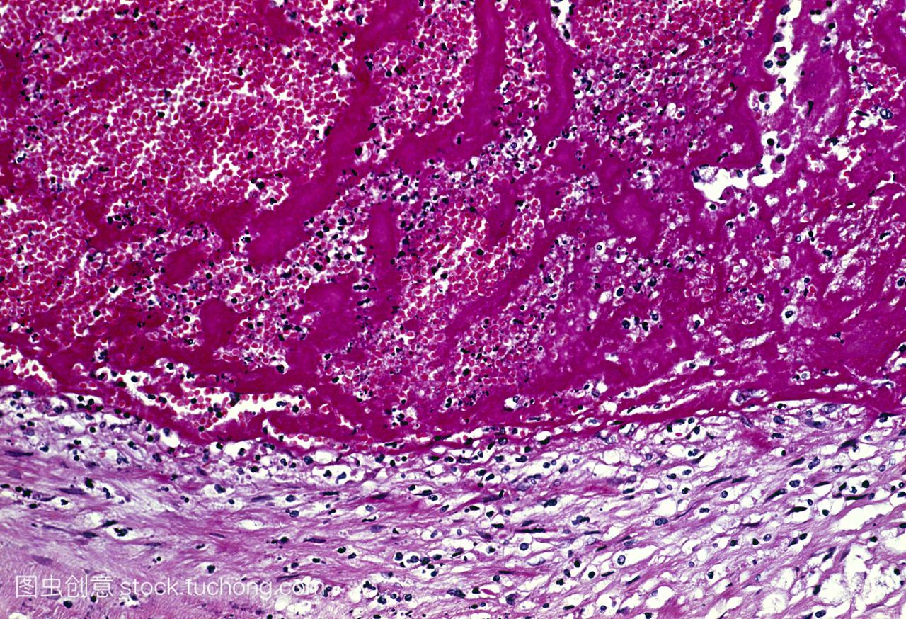 新形成的血栓血块深粉红色在动脉壁浅粉损害了