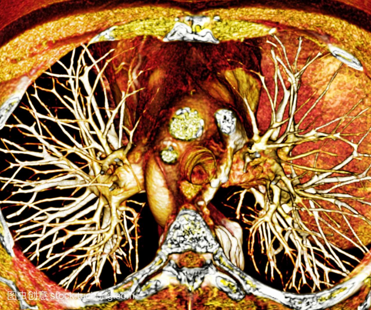 心脏和肺,3d-ct扫描。彩色3d计算机断层扫描c