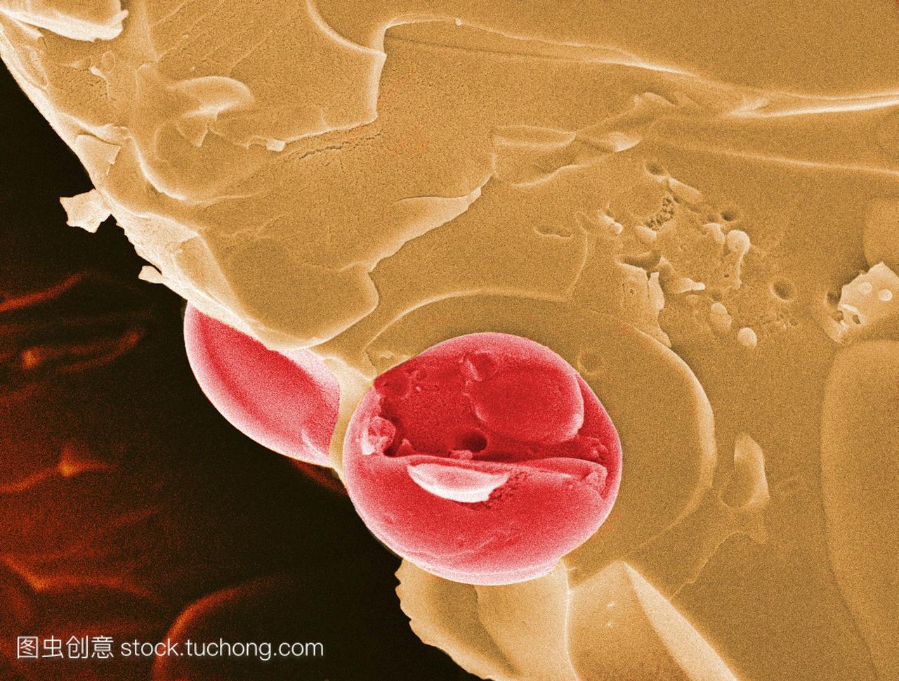 疟疾的血液细胞。彩色扫描电子显微摄影SEM