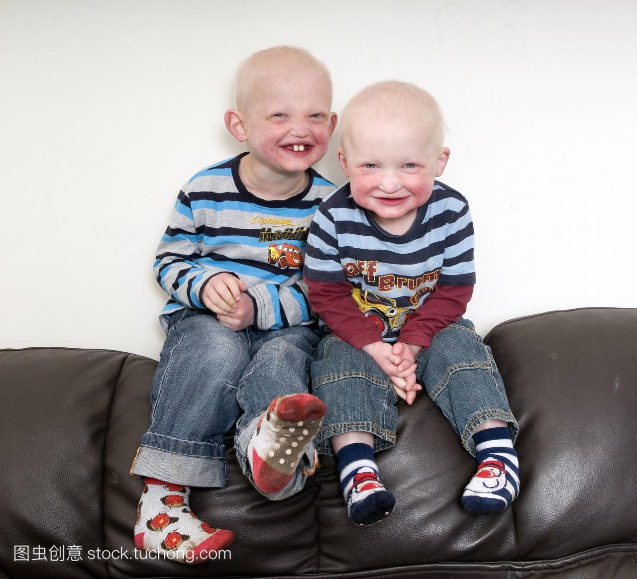 模型发布与遗传条件外胚层发育不良两个年轻男