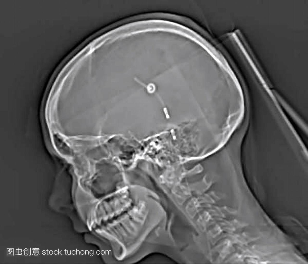 脑分流。一名17岁妇女大脑中一个蛛网膜囊肿