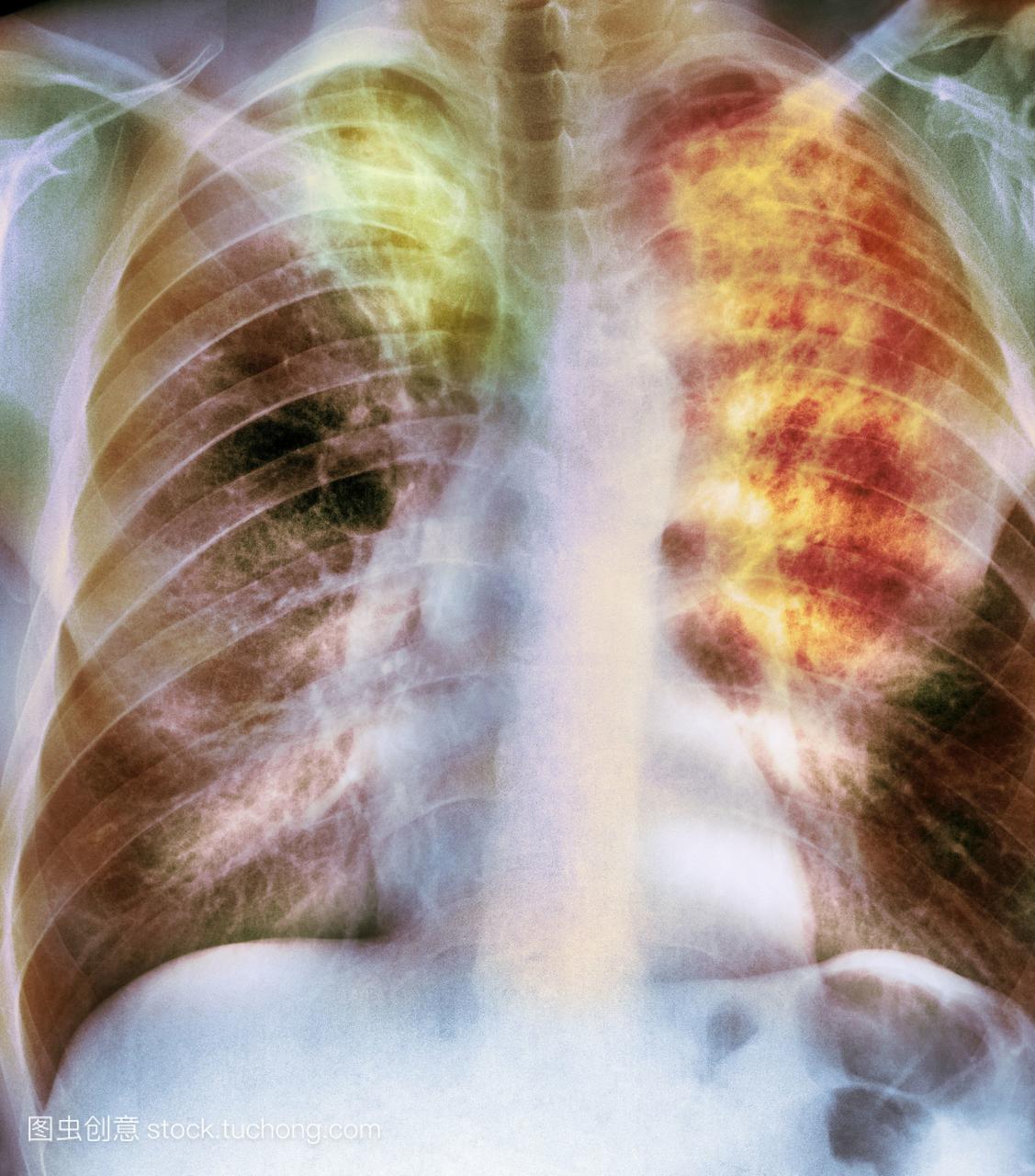 前视图的胸部一个50岁的男性病人显示肺部纤