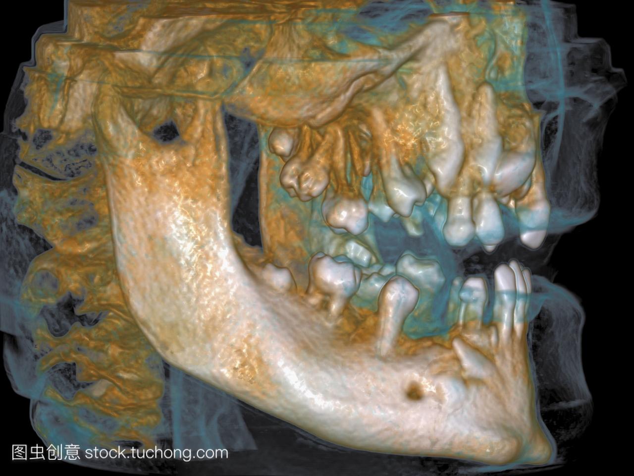Cleidocranial发育不良3dCT扫描。侧面的三维